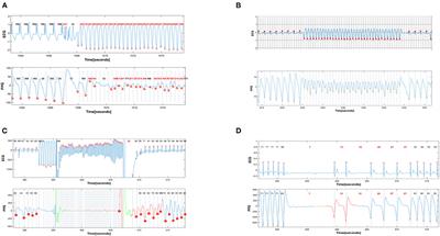 Continuous Heart Rate Monitoring for Automatic Detection of Life-Threatening Arrhythmias With Novel Bio-Sensing Technology